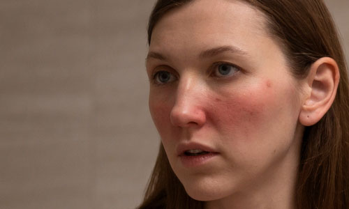 best facials for rosacea featured image